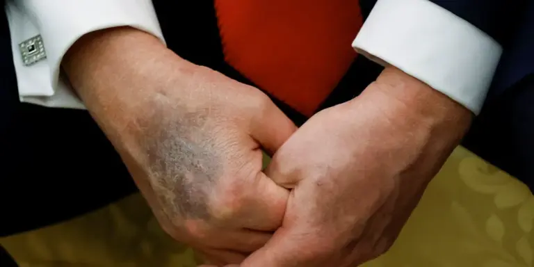 Analysis reveals why MAGA chooses to buy Trump’s ‘perfect’ health lie